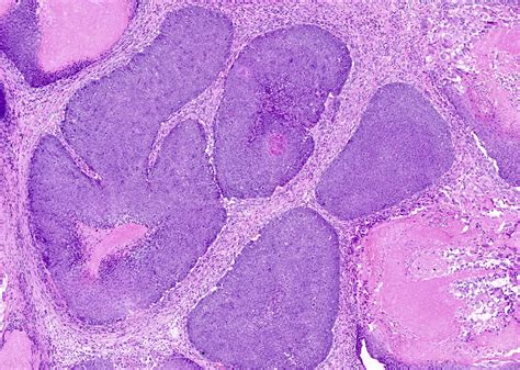 Pilomatricoma Histology