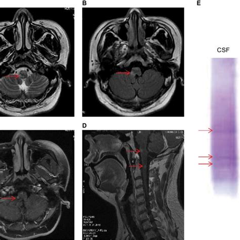 MRI findings and OB found in the CSF on admission. Notes: MRI of the ...