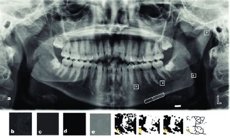 Panoramic Radiograph With The Five Selected Interest Areas 1 Interest