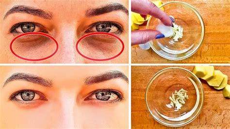 How to Get Rid of Black Circles Under Your Eyes