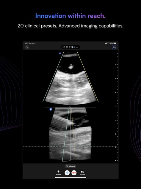 Butterfly iQ — Ultrasound App for iPhone - Free Download Butterfly iQ ...