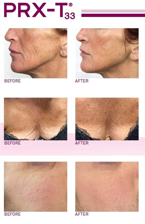 Prx T Tca Bio Revitalisation In Richmond Chemical Peel