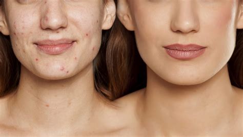 Acne Program Anewskin Aesthetic Clinic And Medical Spa