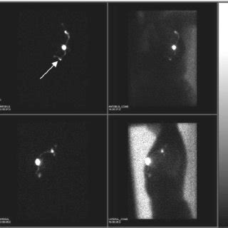 Sentinel node imaging showing two sentinel nodes: Direct lymphatic ...