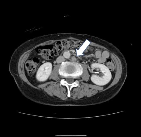 Figure 2 From Surgical Excision For Para Aortic Lymph Node Metastases