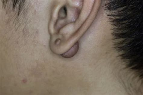 EAR KELOID EXCISION | Park Dermatology