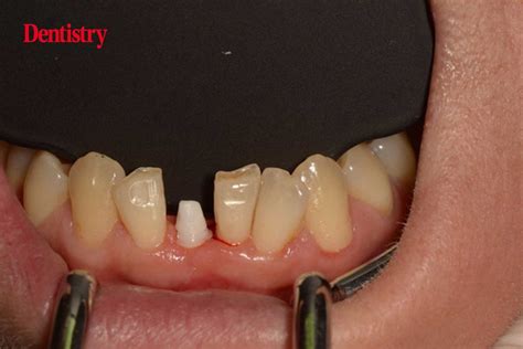 Bredents Whitesky Implants With Dr Holger Scholz Dentistry Co Uk