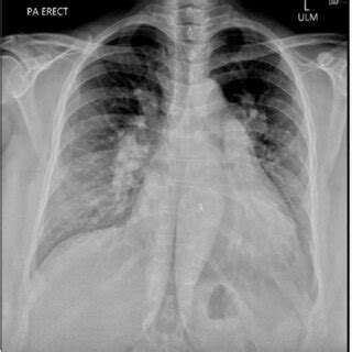 Preoperative Chest X Ray Showing Cardiomegaly And Interstitial Markings