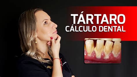 O Que Acontece Se N O Removermos O T Rtaro C Lculo Dental Youtube