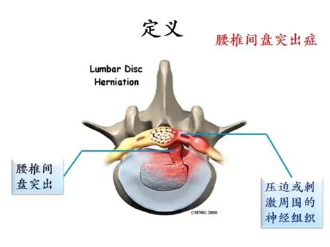 腰椎间盘突出症的分型及治疗策略 好医术早读文章 好医术 赋能医生守护生命