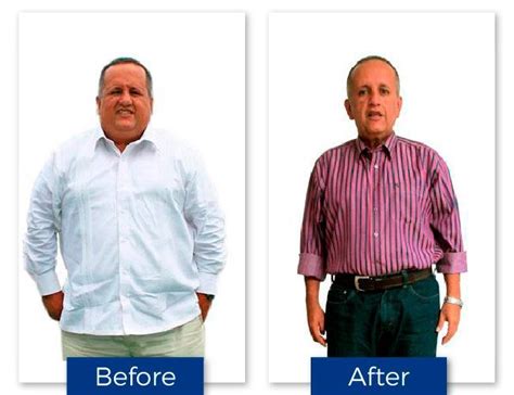 dr-arias-before-after7 - Dr. Rafael Arias