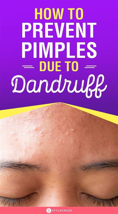 How To Prevent Pimples Due To Dandruff Artofit