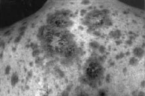 Figure 1 From Erythema Multiforme Like Subacute Cutaneous Lupus