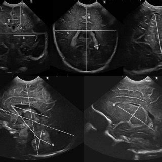 Ultrasound Images Giving Overview Of Neonatal Cerebral Measurements A