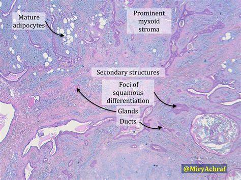 Syringoma Histology