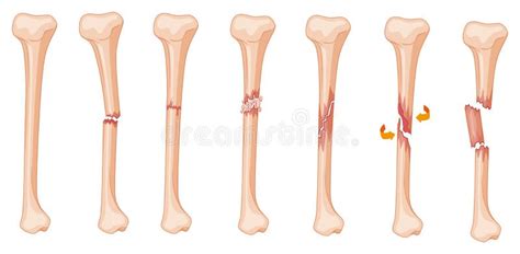 Diagrama Da Fratura Do Pé Em Fases Diferentes Ilustração Do Vetor Ilustração De Diagrama