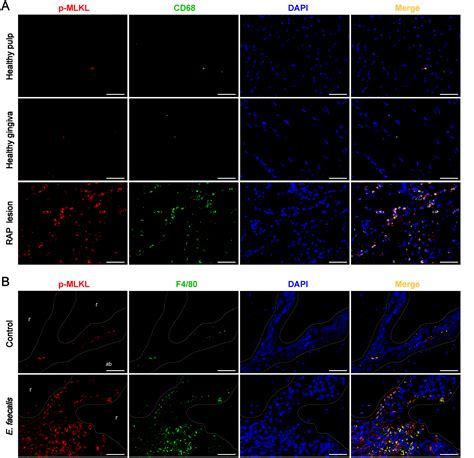 Enterococcus Faecalis Induced Macrophage Necroptosis Promotes