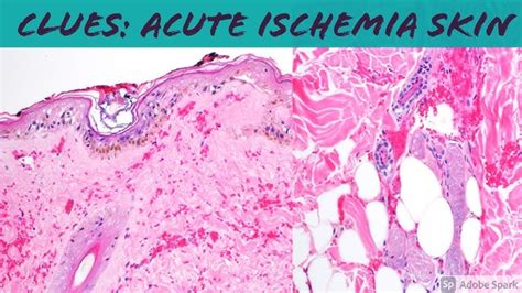 Staphylococcal Scalded Skin Syndrome Histology