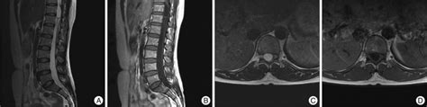 The Magnetic Resonance Image Revealing A Well Defined Cystic Lesion On Download Scientific