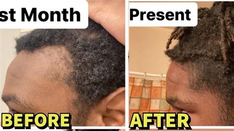 Insane Microneedling Before After Results For Hair Regrowth Must