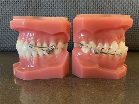 What Is A Carriere Appliance And How Is It Used — Cook Orthodontics Of Dublin