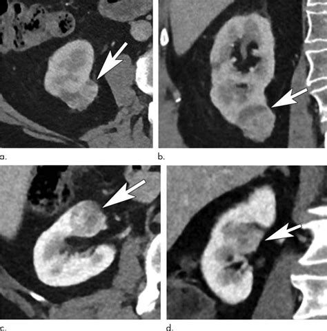 Renal Tumors Show Low And High Image Eurekalert Science News Releases