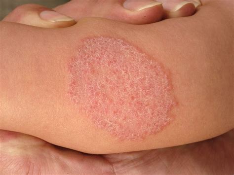 Ringworm Tinea Corporis Patientenfolder The Best Porn Website