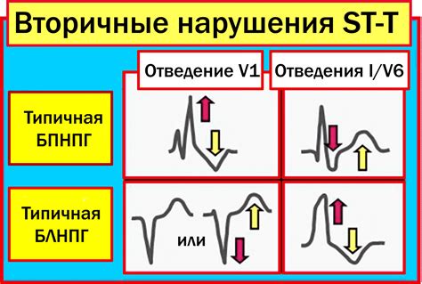 Блог по клинической электрофизиологии: Клинический разбор (блокада ...