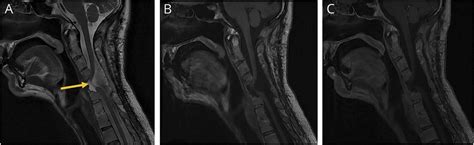 Teaching NeuroImages Spinal Cord Herniation After Cervical Corpectomy