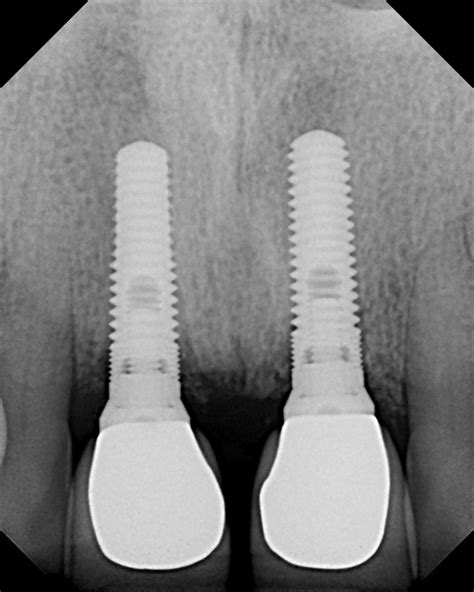 Dental Implant X Rays Dental Implant Dentistry Blog