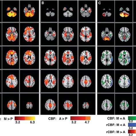 Statistical Maps Of Regional Cerebral Blood Flow Cbf Variations A