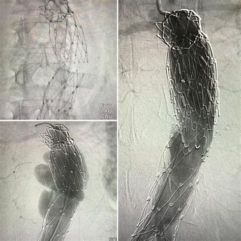 Detailed description of patients with type III endoleak. | Download ...