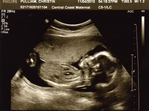 Seven Is Our Lucky Number: Ultrasound 19 weeks