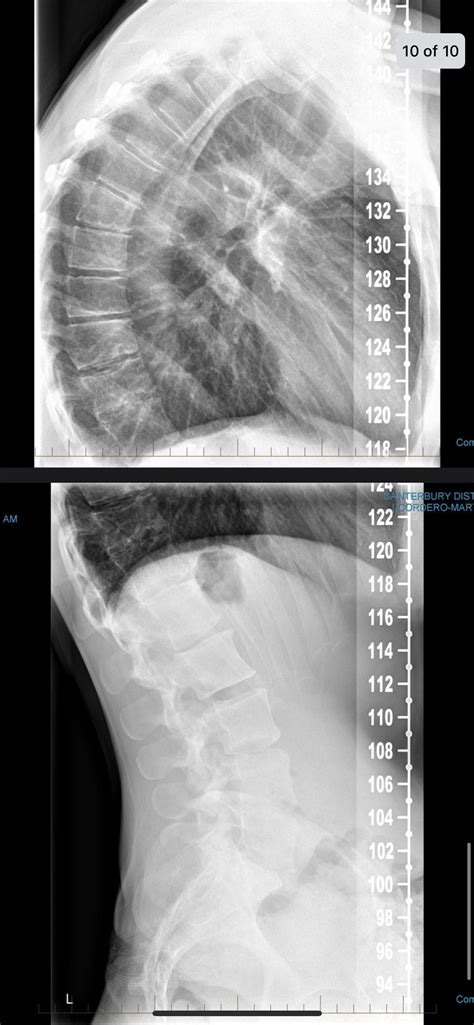Would You Consider My Kyphosis Moderate Or Severe Rkyphosis