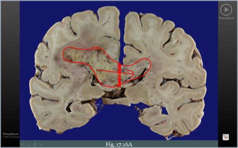 Adult Brain Tumors Flashcards Quizlet