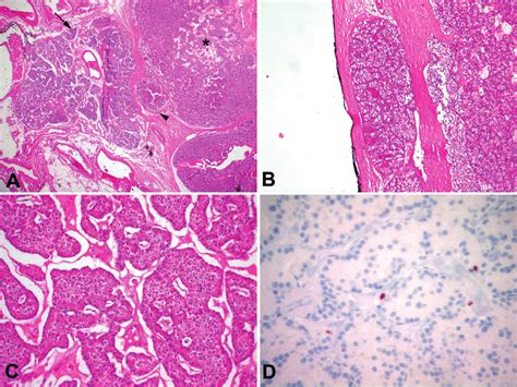 A Atypical Parathyroid Adenoma Normal Parathyroid Tissue Arrow Is