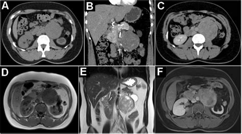 A B C Tc Abdominal Exibindo Volumosa Les O Expansiva Localizada Na