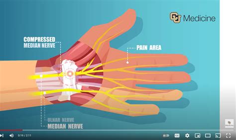 Carpal Tunnel Syndrome Andrew Federer Md Hand Specialist Denver Co