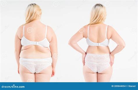 Woman S Fat Body Before And After Weight Loss Plastic Surgery And Liposuction Concept On Light