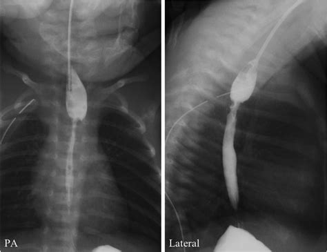 Frontiers Refractory Tracheoesophageal Fistula Treated Using Multi