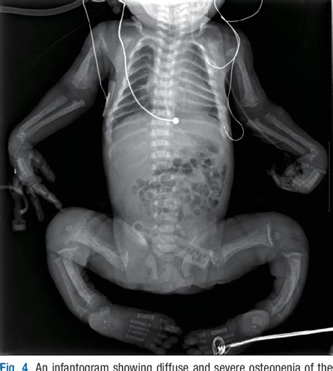 Figure From A Case Of Mucolipidosis Ii Presenting With Prenatal