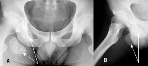 Heterotopic Ossification An Active 32 Year Old Man Presented With A Download Scientific