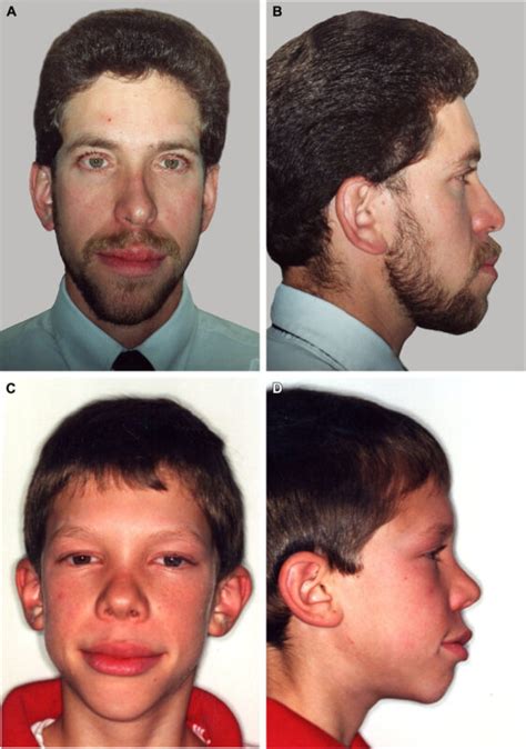 Multiple Endocrine Neoplasia Type 2b Men2b What Patients Should Know