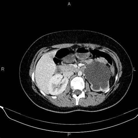 Severe Ureteropelvic Junction Obstruction Image