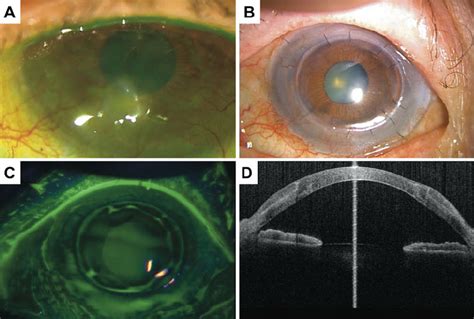 Ad Case Steven Johnson Syndrome Sjs A Total Limbal Stem Cell