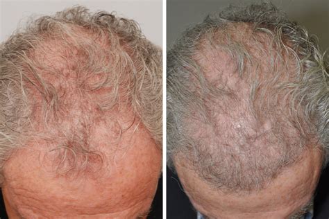 Hair Restoration For Men Dr David Rosenberg