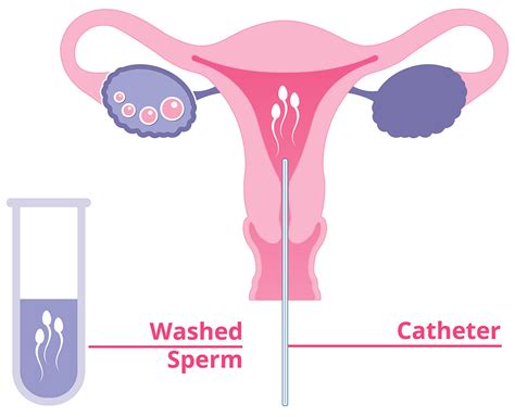 Intrauterine Insemination Iui Procedure Risks Success Rates Irms