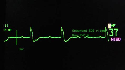 Sinus Rhythm Third Degree Complete Av Block Ventricular Escape