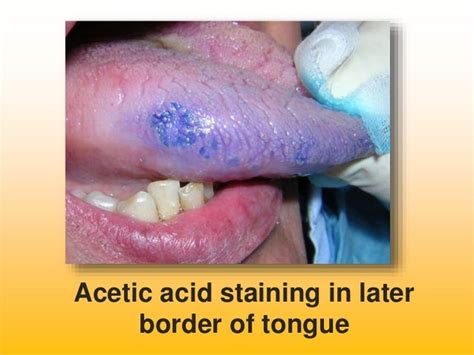 Diagnostic Aids In Oral Cancer