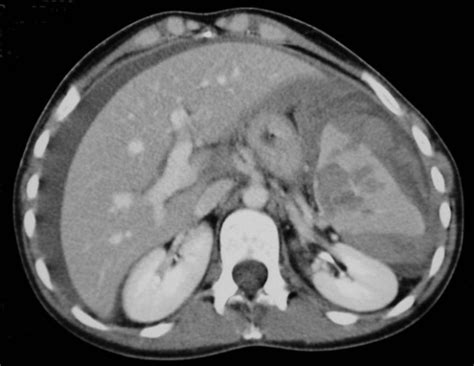 Case 1 Contrast Enhanced Ct Cect Demonstrates A Splenic Laceration